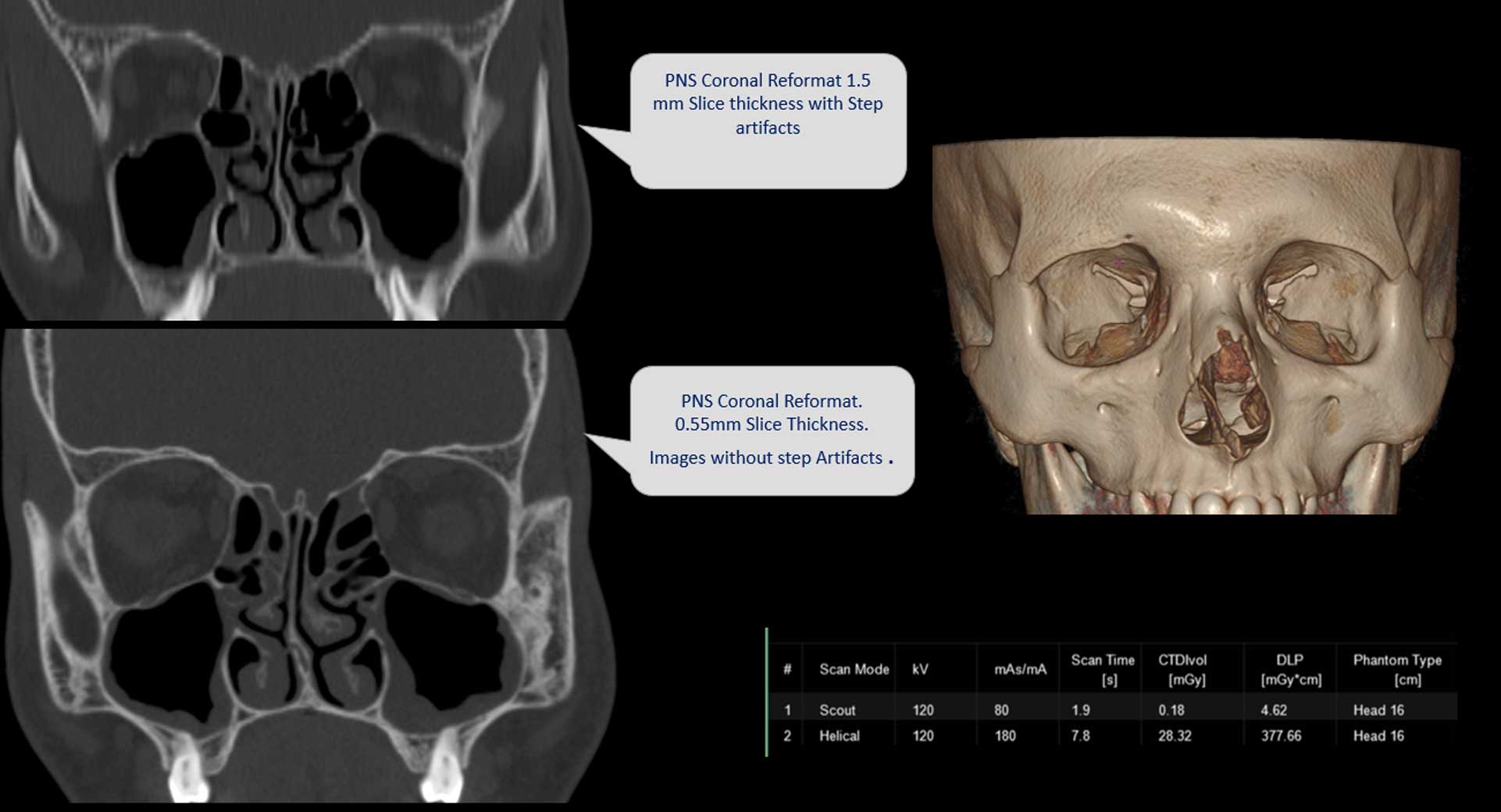 PNS-(Para-Nasal-Sinus)