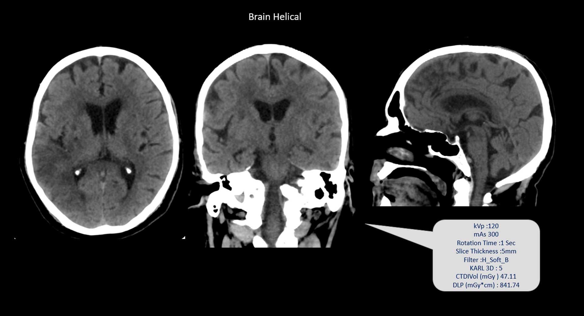 Helical-CT