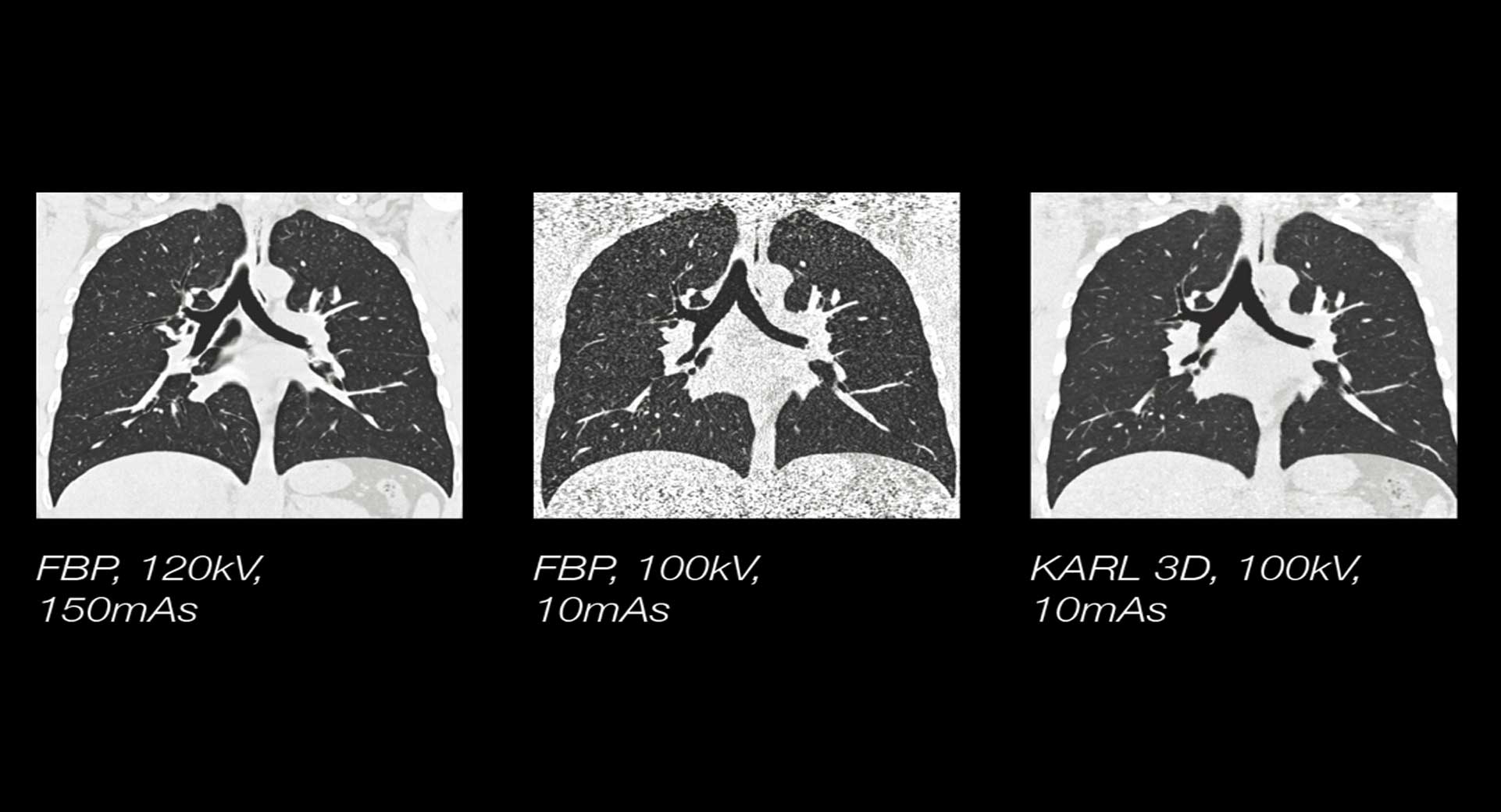 KARL-3D-Iterative-Denoising