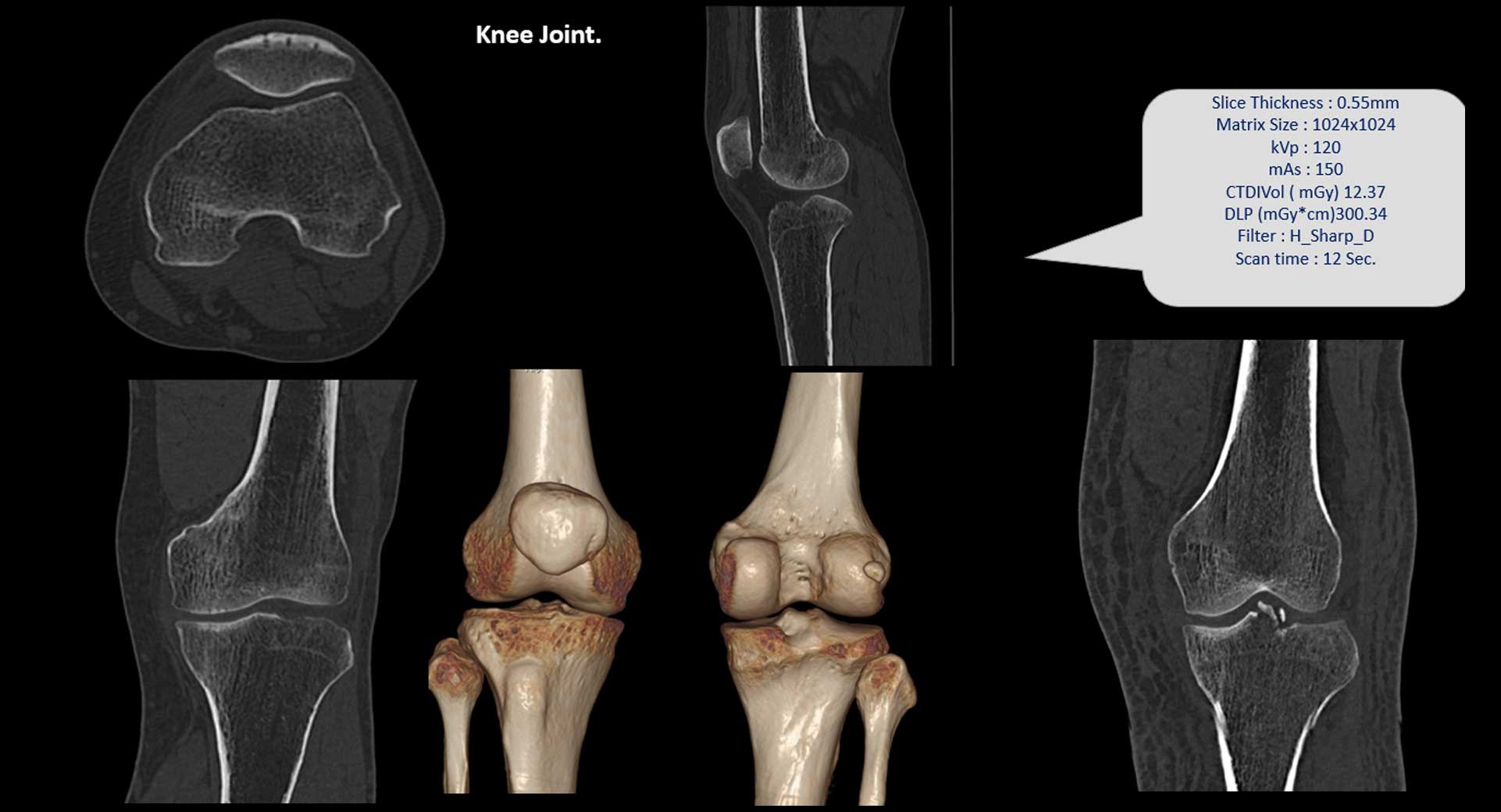 Knee-Joint--X-ray