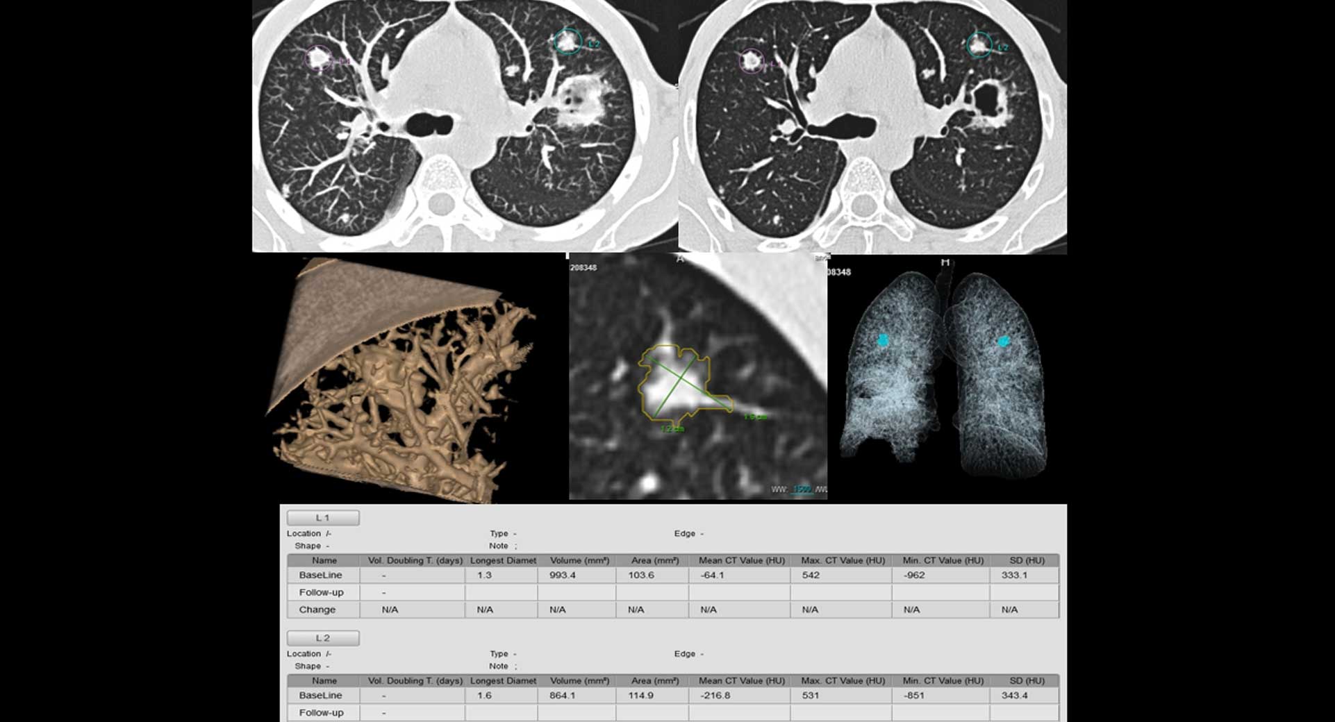 Nodule-detection